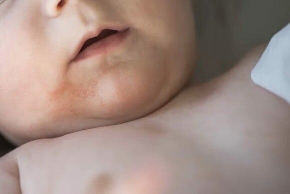Baby with a rush on his skin 