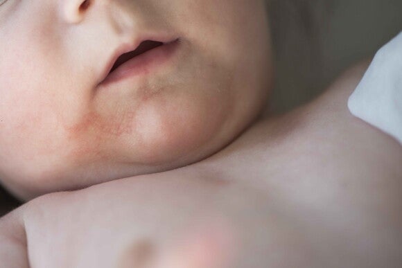 Eczema is part of the symptoms of baby allergies that you must be aware of A child with eczema, one of the symptoms of baby allergies.